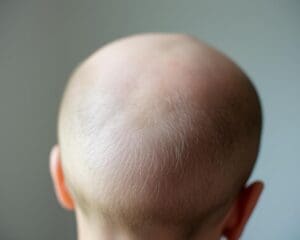 Was sagt deine Kopfhaut über deine Gesundheit?